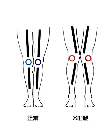 x型腿