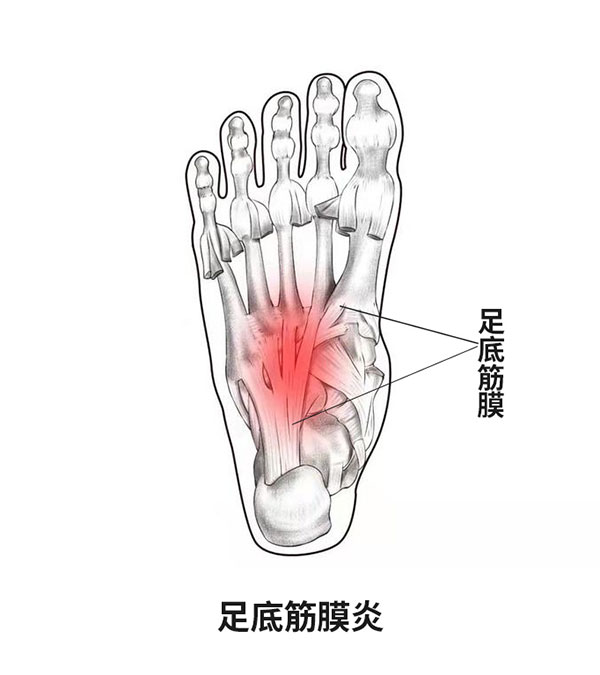 足底筋膜炎